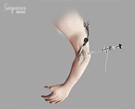 Minimally Invasive Hand and Wrist Surgery: How Keyhole Techniques Help You Heal