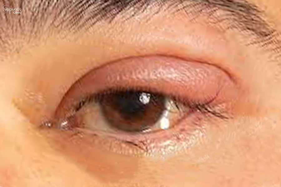 Watery Eyes and Tear Duct Problems? Here’s What You Need to Know About DCR Surgery