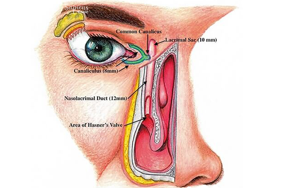 Say Goodbye to Watery Eyes with DCR (Tear Duct Bypass Surgery)