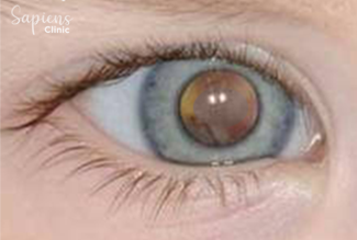 Ocular Removal Procedures: Medical Reasons, Process, and Recovery