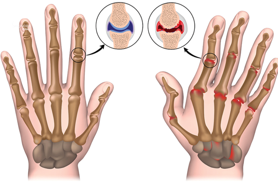 Rheumatoid Arthritis Awareness: What You Need to Know