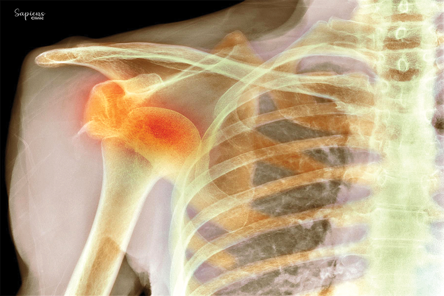 Dislocated Shoulder? Here’s What You Need to Know About Treatment and Healing