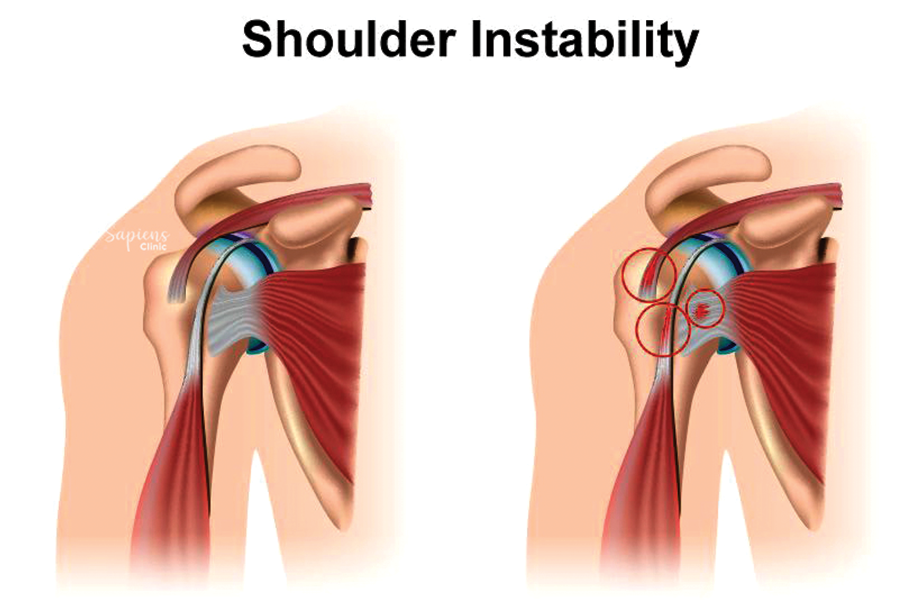 Managing Shoulder Instability: From Diagnosis to Recovery
