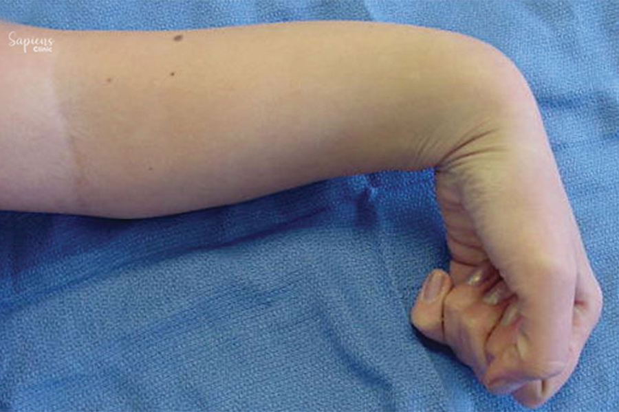 Understanding Spastic Hand Deformity: Managing Muscle Tightness and Function