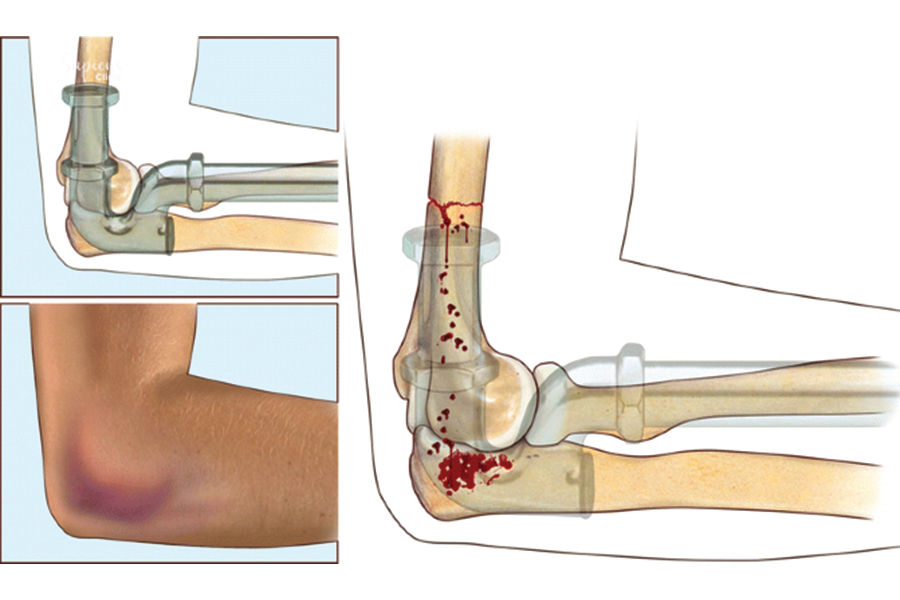 Managing Elbow Stiffness: Medical Treatments and Rehabilitation