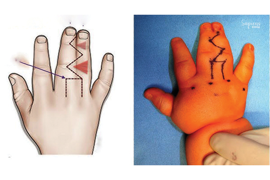 Innovations in the Treatment of Congenital Hand Anomalies
