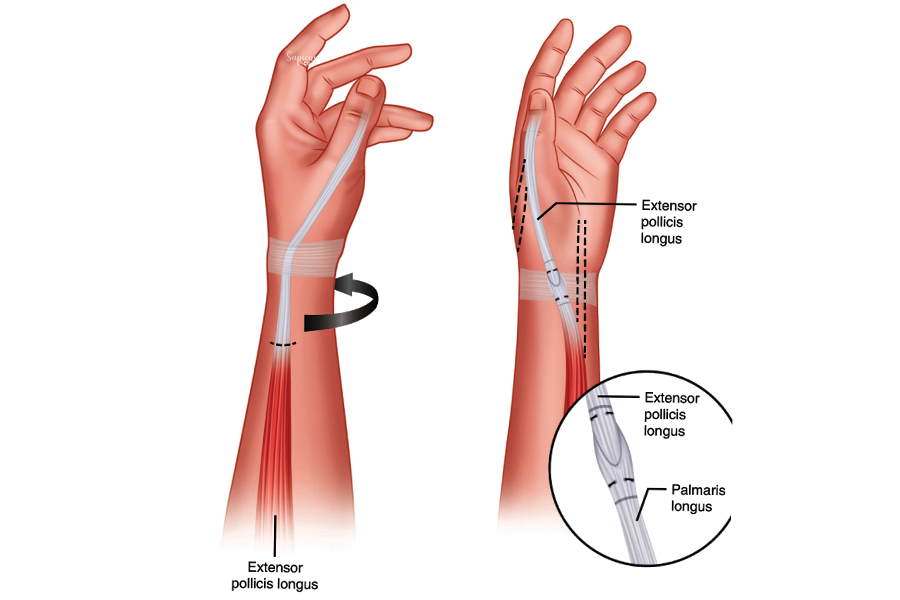 Regaining Function After Injury: The Role of Tendon Transfer Surgery
