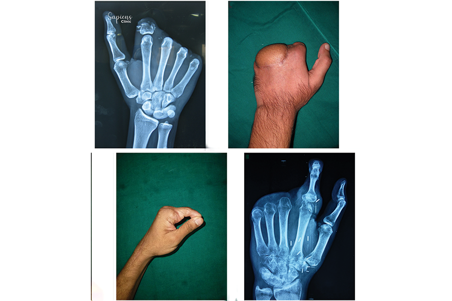 How Toe Transfer Surgery Can Help Restore Hand Function After Injury